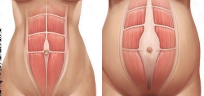 00-diastsis-new-post-