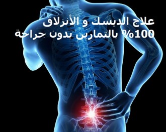 علاج الانزلاق الغضروفي و الانزلاق الغضروفي بالتمارين بدون جراحة ايجي فتنس