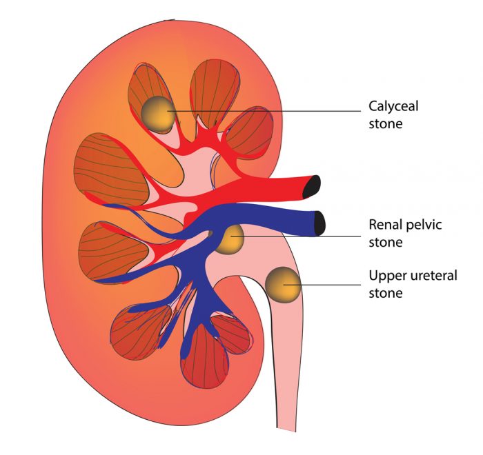 Calcium kidney stones 